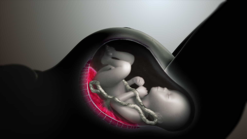 obstetric fistula - ऑब्स्टेट्रिक फिस्टुला