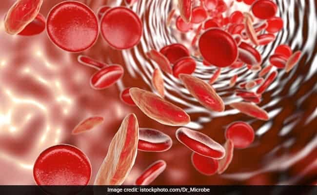 Sickle cell disease: सिकल सेल रोग क्या है?