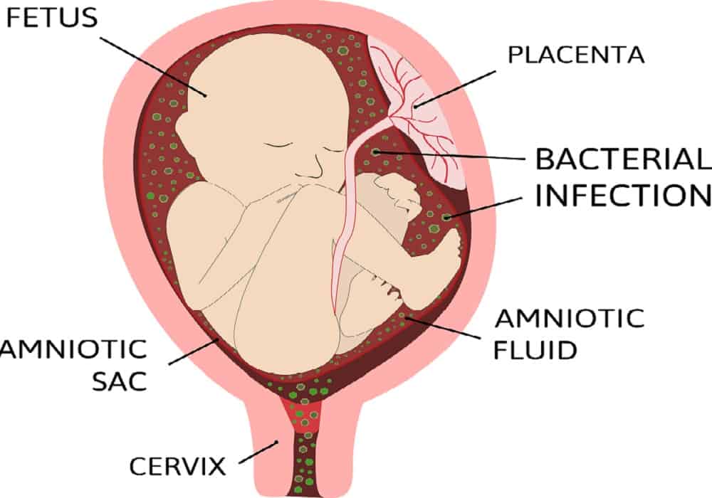 इंट्रायूटेराइन इंफेक्शन क्या है? क्या गर्भ में पल रहे बच्चे के लिए हो सकता है हानिकारक