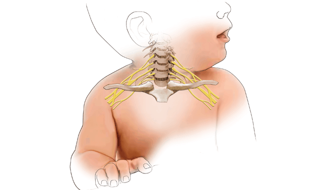 Brachial plexus nerve injury:  ब्रेकियल प्लेक्सस नर्व इंजरी क्या है?