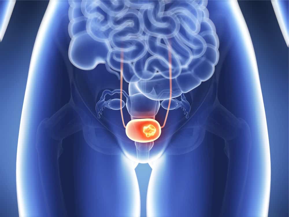 Prostate cancer in women