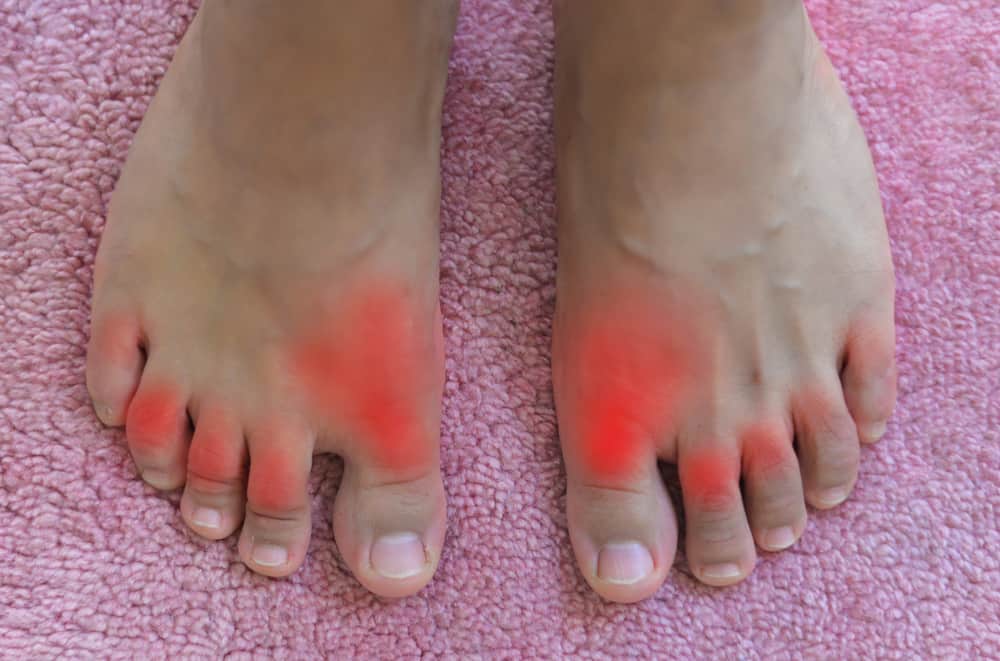 Hyperuricemia : हाइपरयूरिसीमिया क्या है? जानें इसके कारण, लक्षण और उपाय