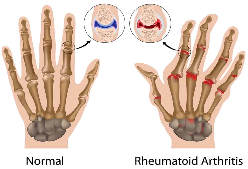 रूमेटाइड आर्थराइटिस का आयुर्वेदिक इलाज क्या है? जानें प्राकृतिक औषधियों के बारे में
