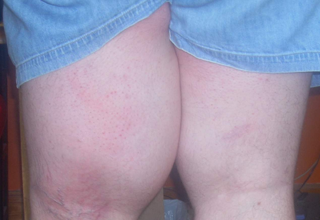 सूजन (एडिमा)- Swelling and edema