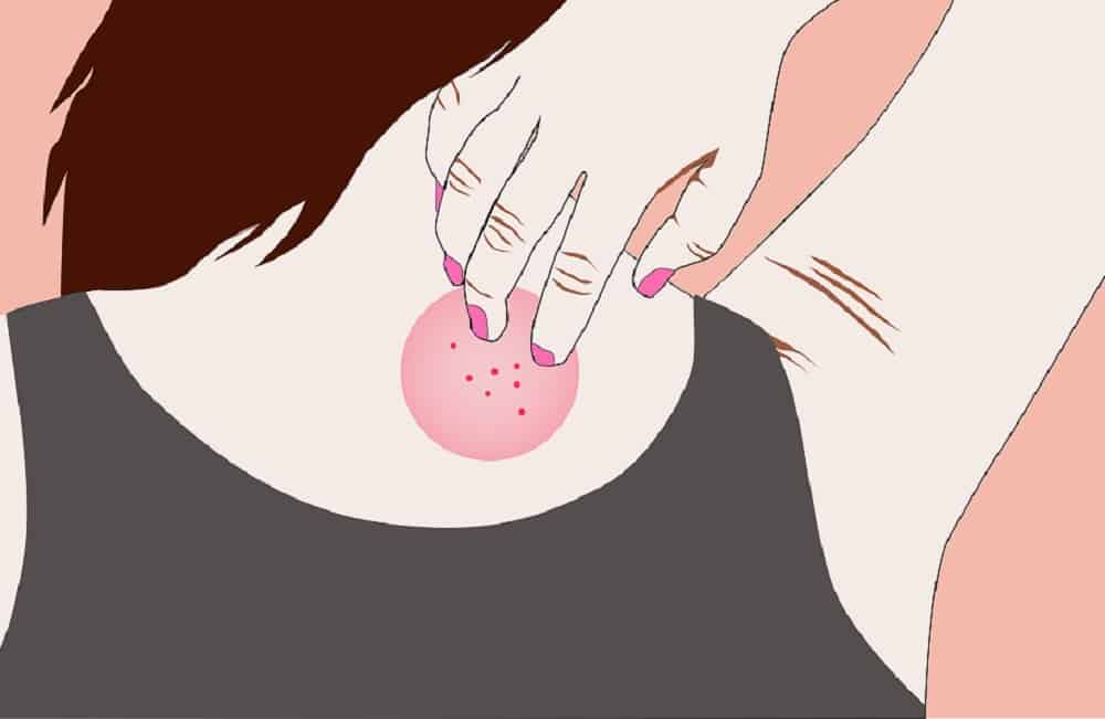 दाद का आयुर्वेदिक इलाज क्या है? जानिए दवा और प्रभाव