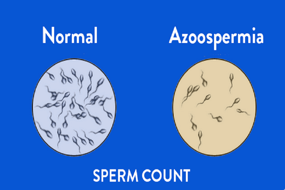 Azoospermia: निल शुक्राणु क्या है? जानें इसके कारण, लक्षण और उपाय