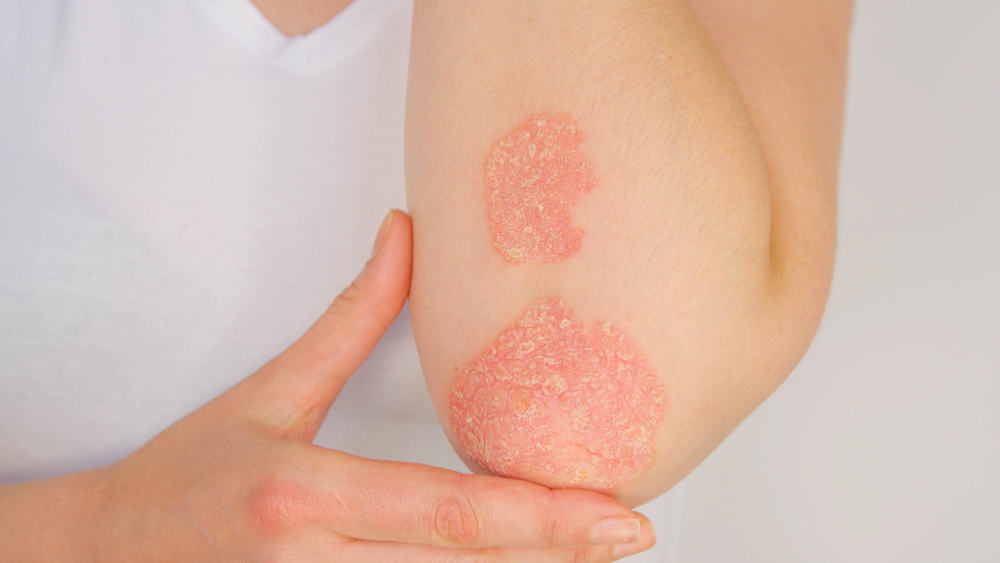 Psoriasis : सोरायसिस इंफेक्शन क्या है? जानें इसके कारण, लक्षण और उपाय