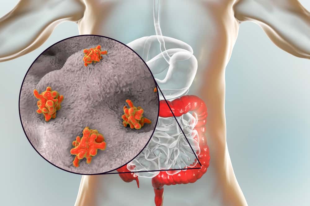 Dysentery: पेचिश क्या है? जानें इसके कारण, लक्षण और उपाय