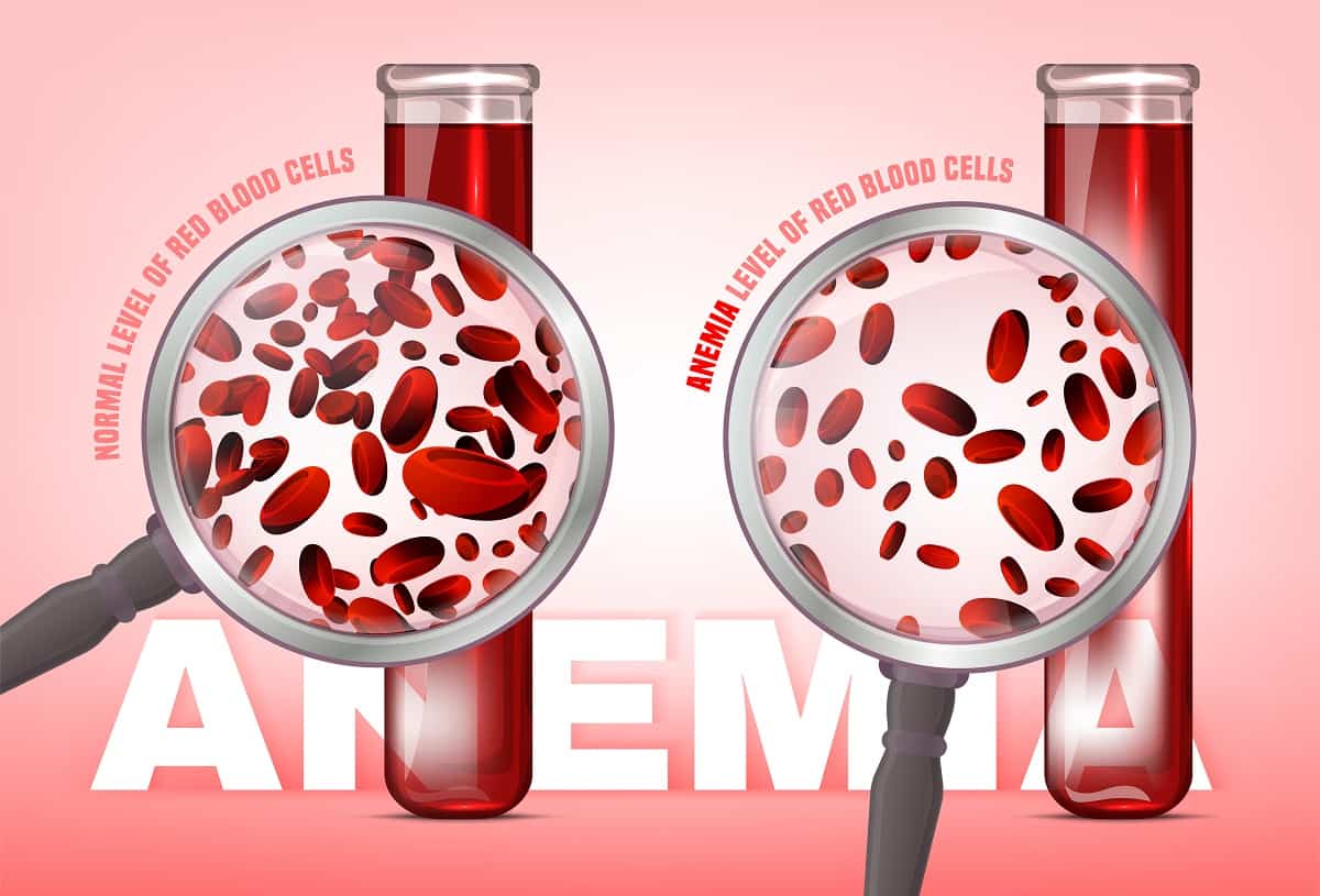 Anemia: रक्ताल्पता (एनीमिया) क्या है? जानें इसके कारण, लक्षण और उपाय