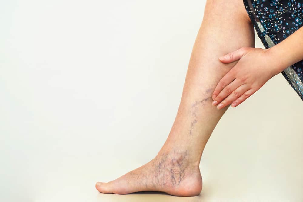 Varicose veins: वैरिकोज वेन्स क्या है? जानें इसके कारण, लक्षण और उपाय