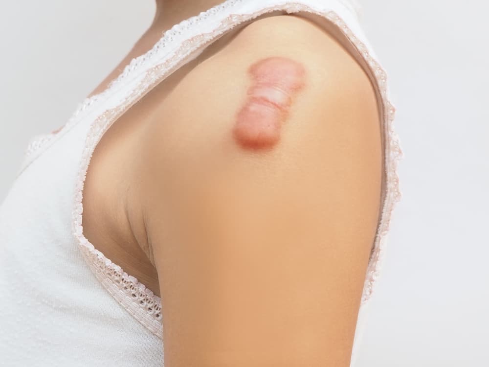 Keloid: केलॉइड क्या है? जानें इसके कारण, लक्षण और उपाय