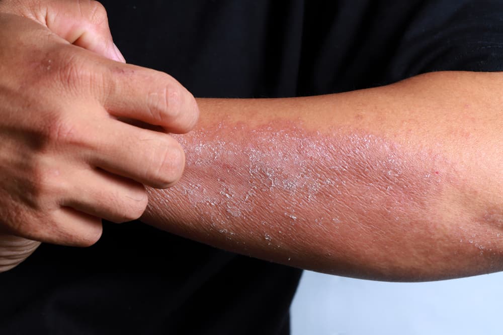 Skin Disorders : चर्म रोग (त्वचा विकार) क्या है? जानें इसके कारण, लक्षण और उपाय
