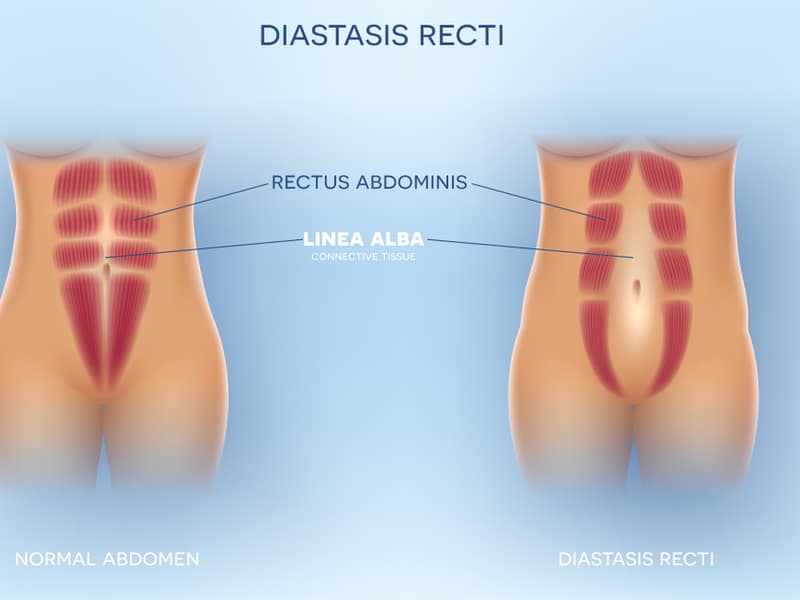डायस्टैसिस रेक्टी : क्या है और कैसे लगाएं इसका पता?