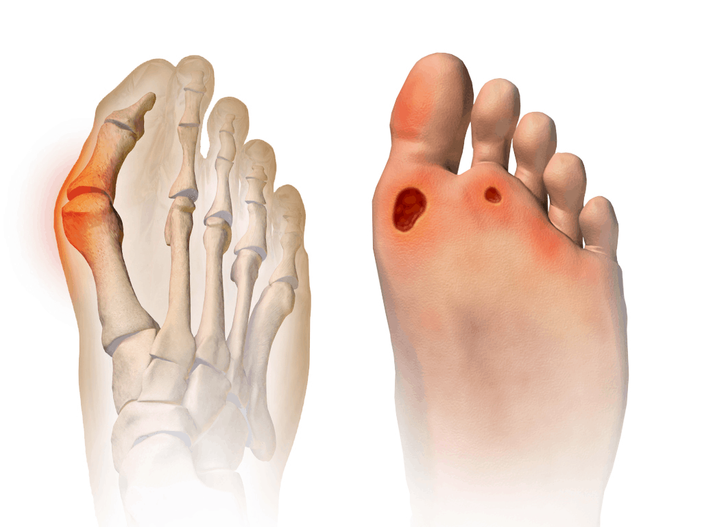 Diabetes Foot Ulcer: Causes, Symptoms, Treatment 