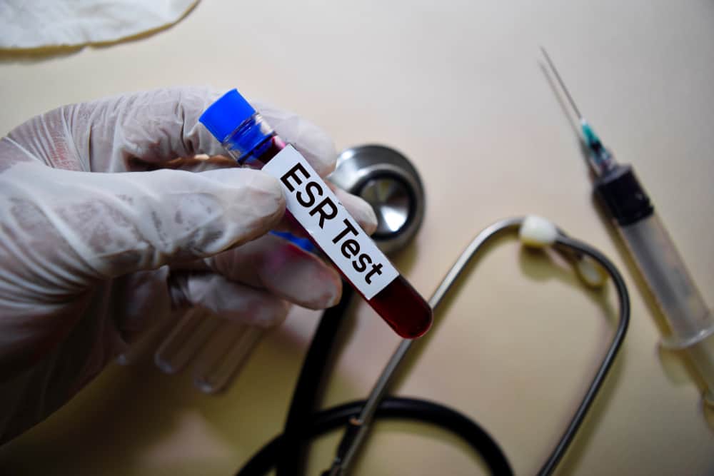 ईएसआर(एरिथ्रोसाइट सेडीमेंटेशन रेट) लेवल को कम करने के लिए कौन से घरेलू उपाय हैं प्रभावी?