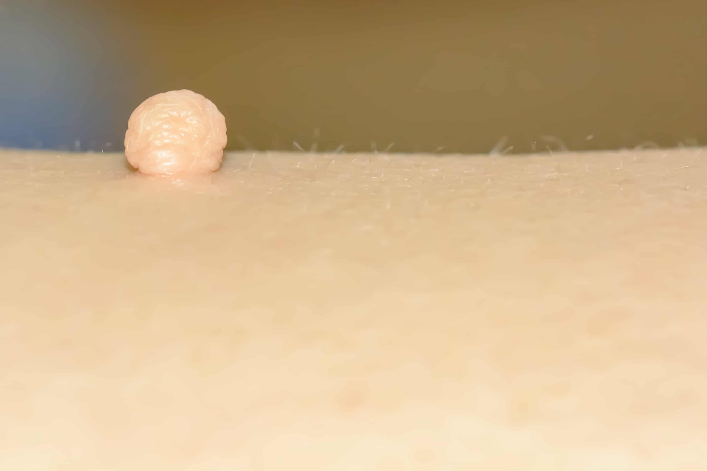 आपके शरीर में दिखने वाले स्किन टैग, हो सकते हैं डायबिटीज का संकेत...