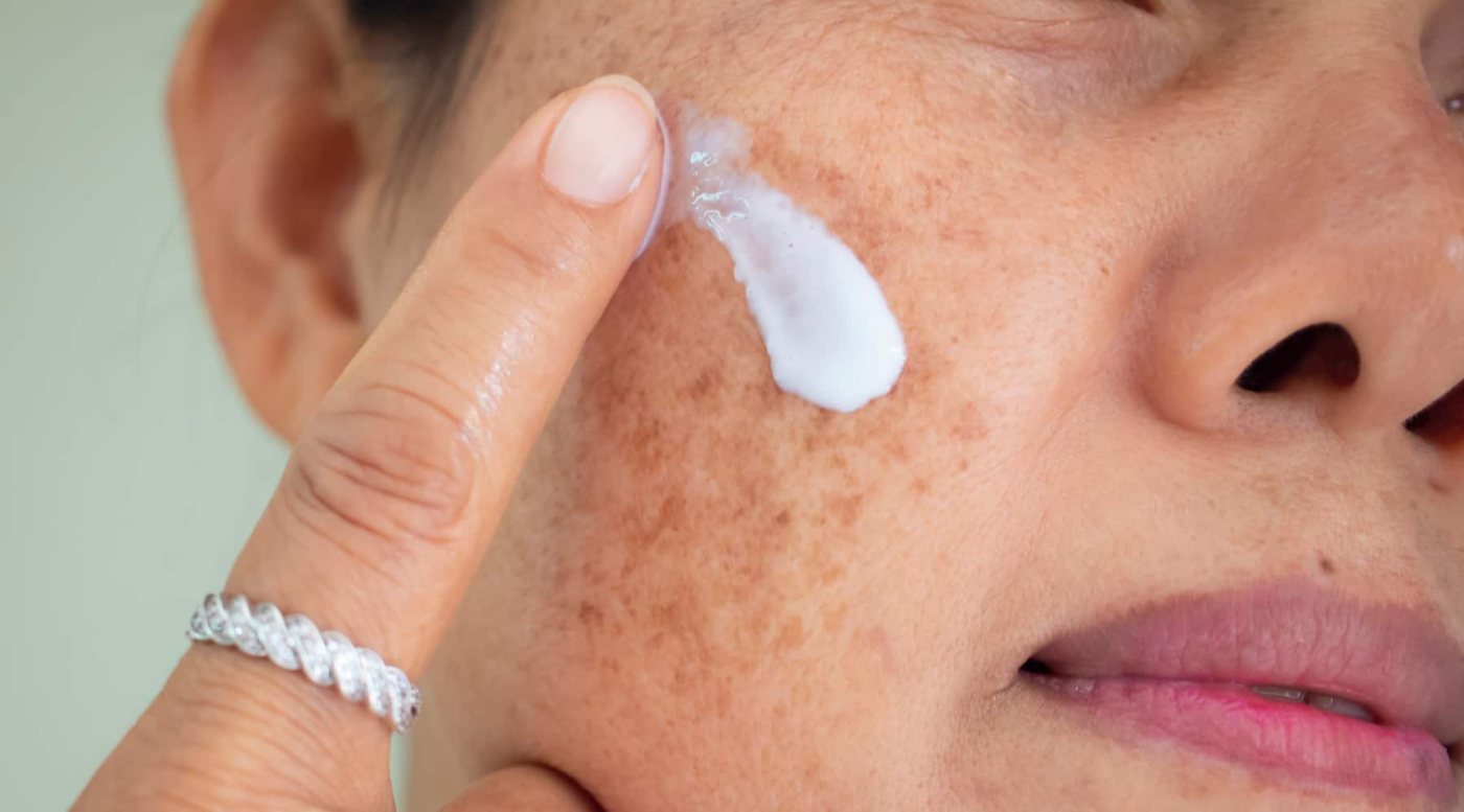 Skinlite Cream: स्किनलाइट क्रीम क्या है? जानिए इसके उपयोग और साइड इफेक्ट्स