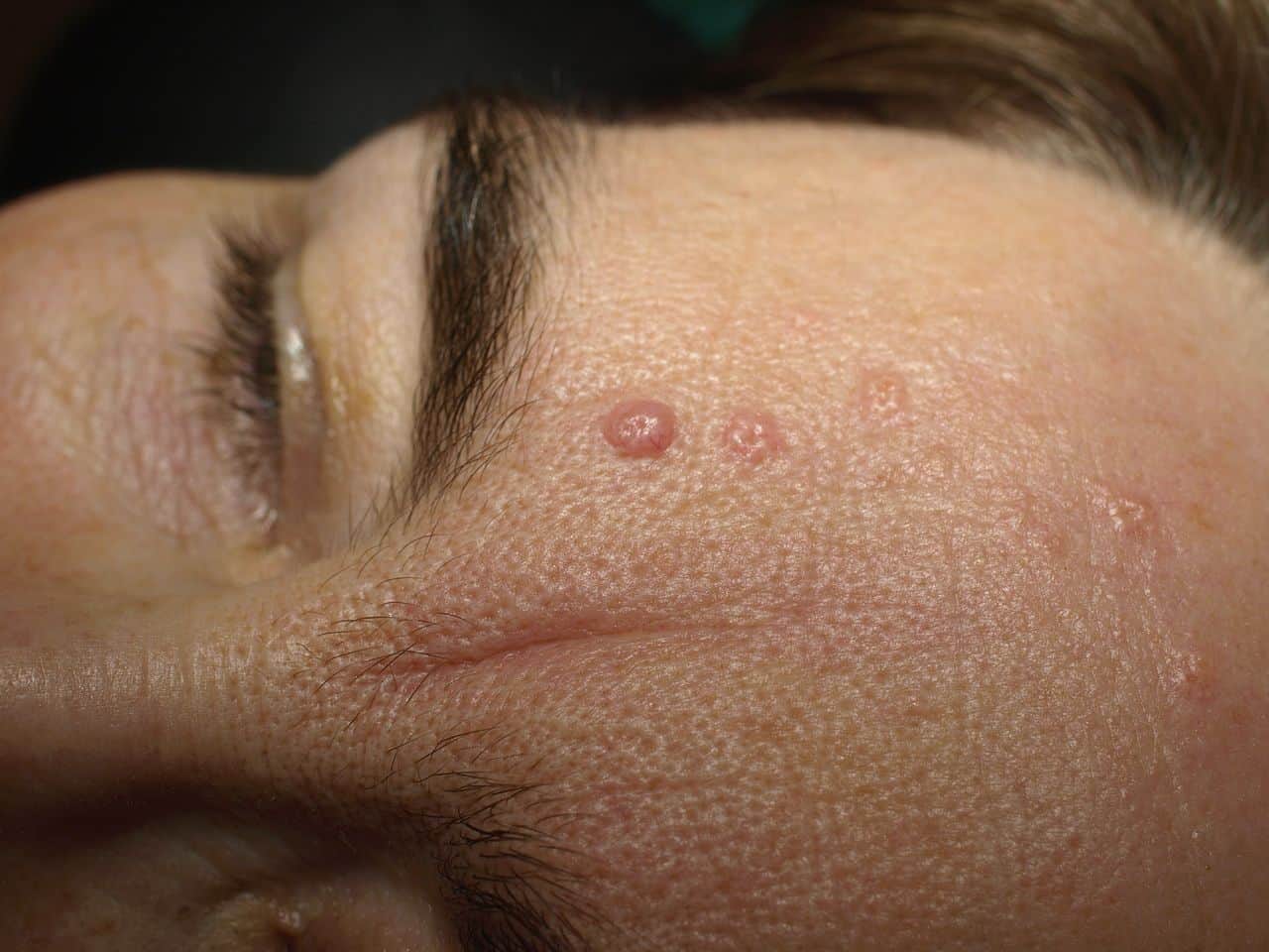 Seborrheic Keratosis: Causes, Symptoms, Treatment
