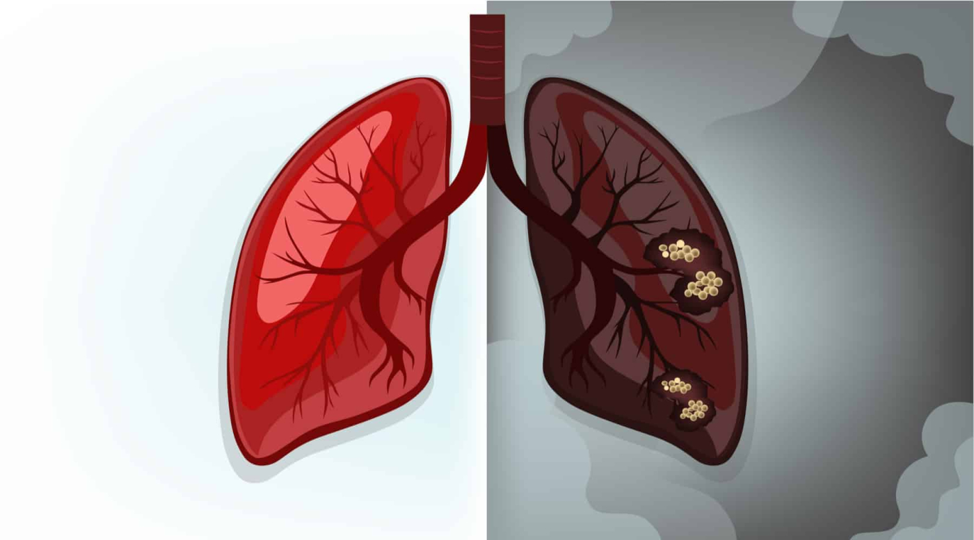 वर्ल्ड लंग्स डे: इस तरह कर सकते हैं फेफड़ों की सफाई, बेहद आसान हैं तरीके
