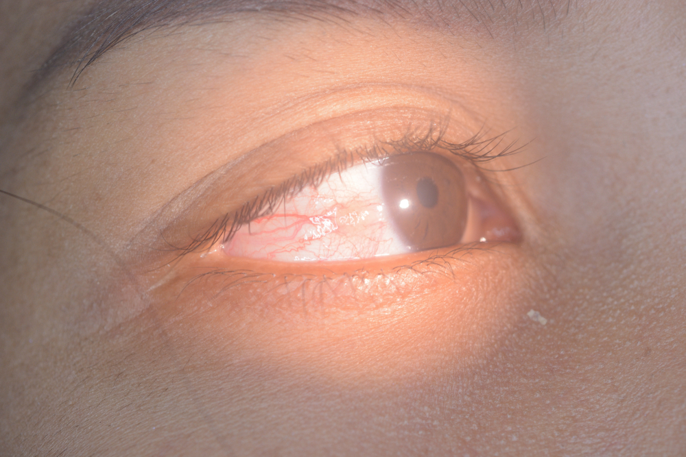 चेहरे की लाली तो अच्छी सेहत की है निशानी, लेकिन क्या कहती हैं आंखों की लाली