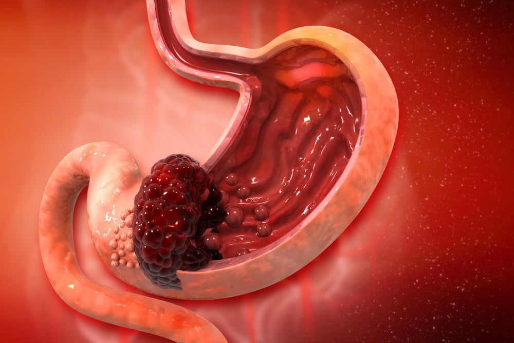 जानिए स्टमक कैंसर की चौथी स्टेज (Stage 4 stomach cancer) पर कैसे होता है मरीज का इलाज