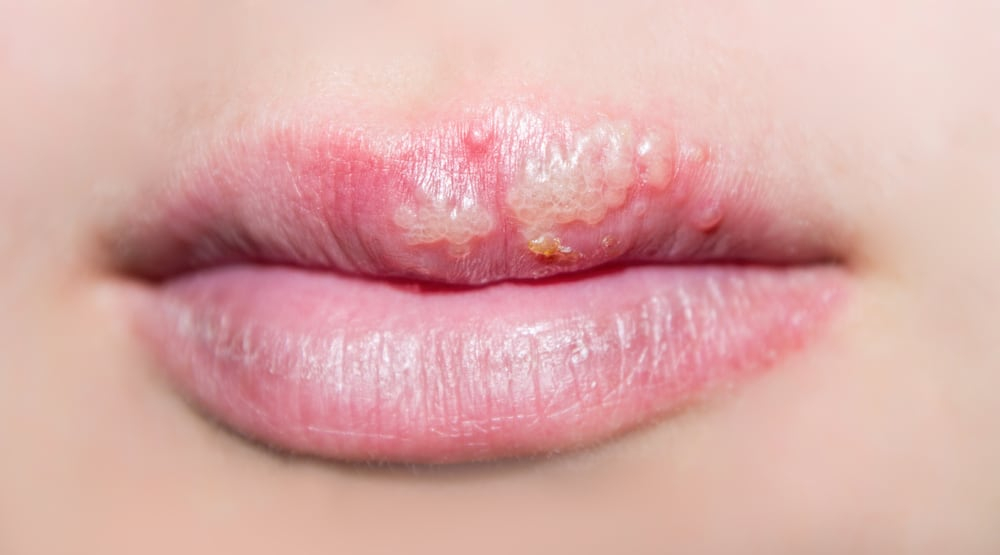 कोल्ड सोर्स या हर्पीज लेबियालिस (Herpes labialis) का ट्रीटमेंट संभव है?