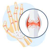 अगर आपका जॉइंट पेन पूरे शरीर में फैल रहा है, तो आप हो सकते हैं माइग्रेटरी अर्थराइटिस के शिकार