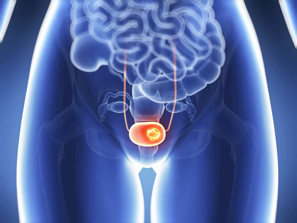 ब्लैडर कैंसर का BCG से इलाज (BCG Treatment for Bladder Cancer) कितना प्रभावी है?