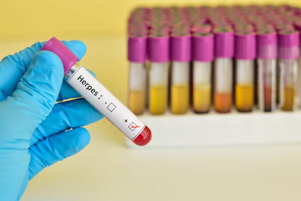 Herpes Simplex: हर्पीस सिम्पलेक्स वायरस से किसको रहता है ज्यादा खतरा?