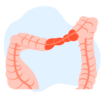 आईबीएस और एल्कॉहल : आंत के मरीजों के लिए शराब का सेवन हाे सकता है खतरनाक!