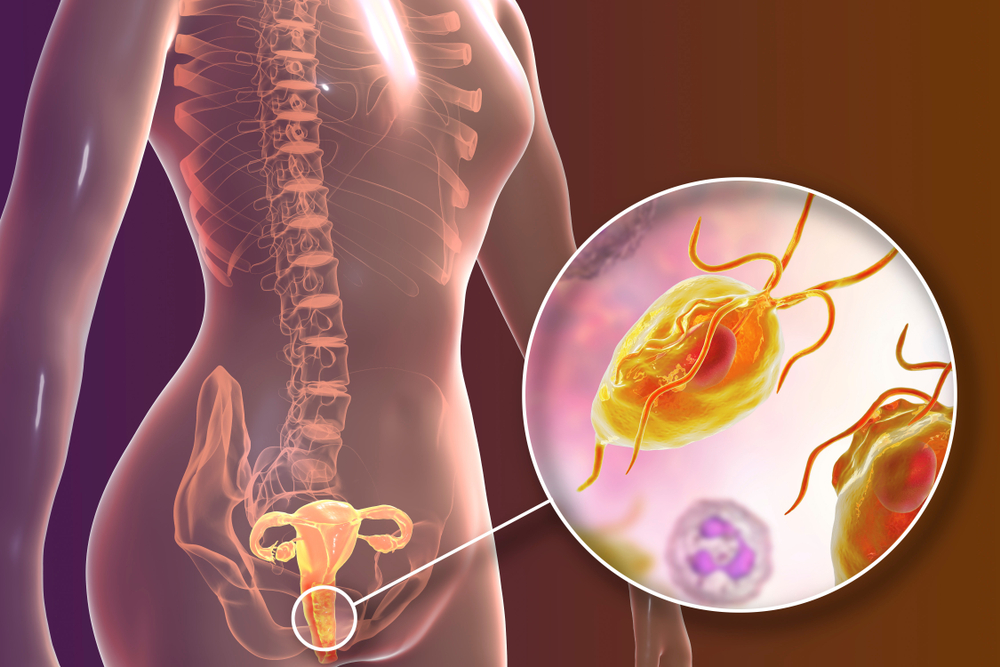 ट्राइकोमोनिएसिस का घरेलू इलाज क्या है?