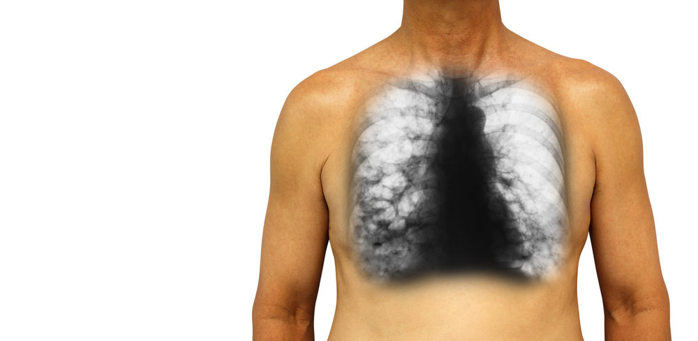 ब्रोन्किइक्टेसिस (Bronchiectasis) : फेफड़ों के इस रोग में आपका लाइफस्टाइल कैसा होना चाहिए, जानिए