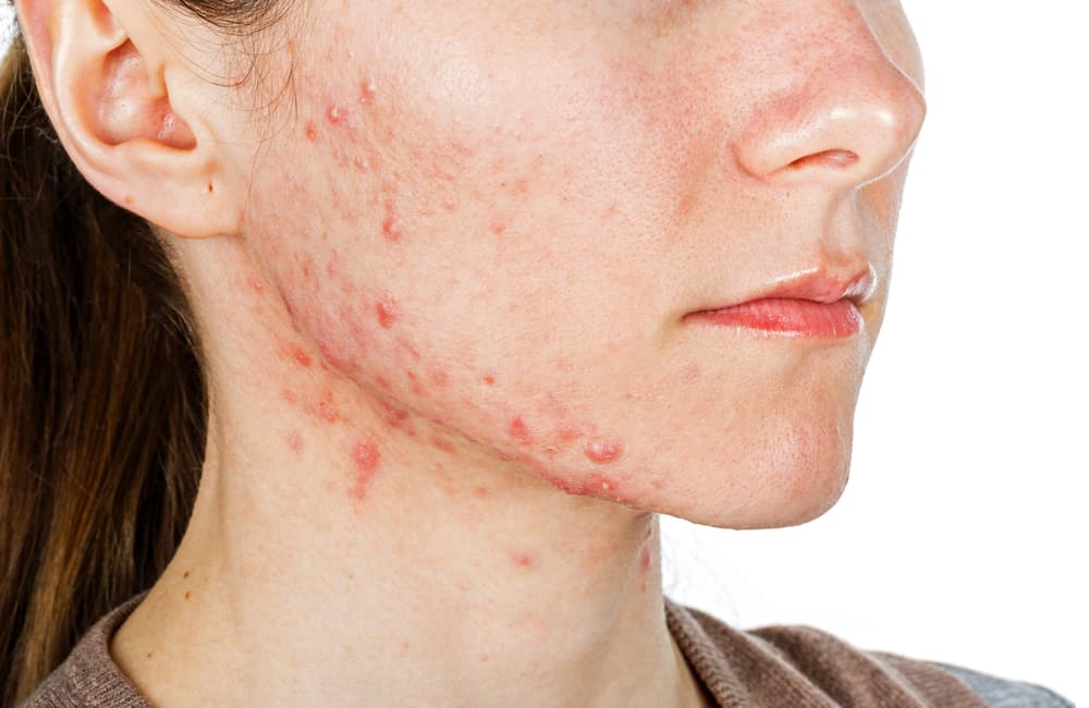 क्या है सिस्टिक एक्ने (Cystic acne) दूर करने का घरेलू इलाज?