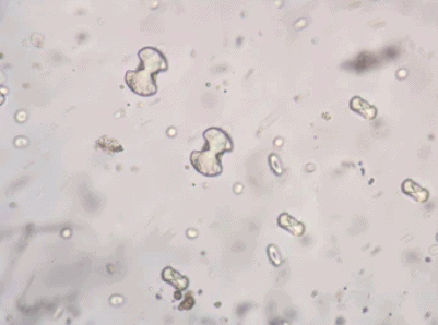 Urine Crystals: यूरिन क्रिस्टल क्या है? क्या यूरिन से संबंधित यह है कोई खतरनाक बीमारी!