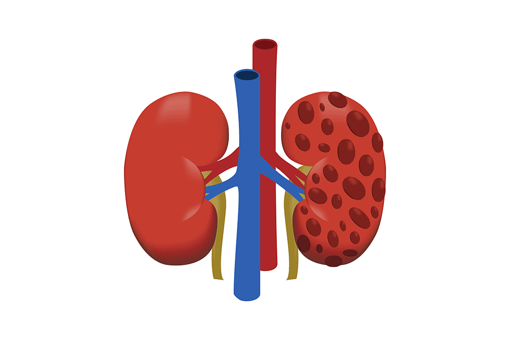 क्या किडनी सिस्ट बन सकती है किडनी कैंसर का कारण?