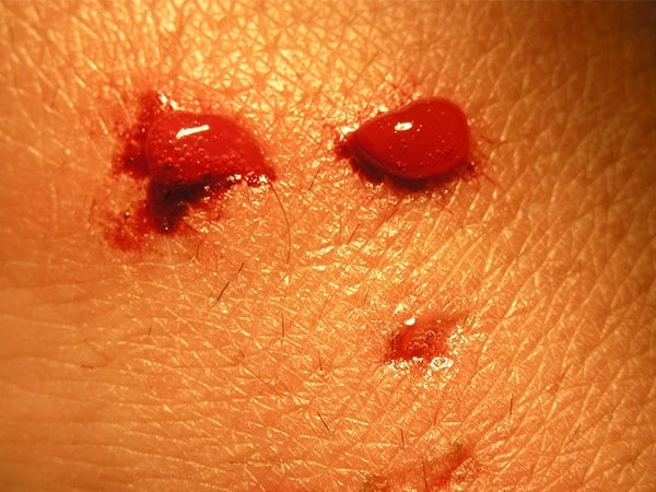 चूहे के काटने पर उसे अनदेखा न करें, अपनाएं ये फस्ट एड उपचार