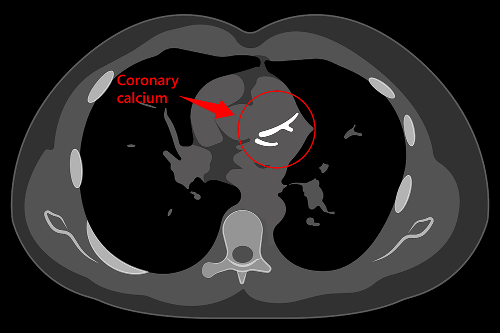 हार्ट अटैक से बचा सकता है कैल्शियम स्कोरिंग टेस्ट (Calcium scoring test), जानिए कैसे