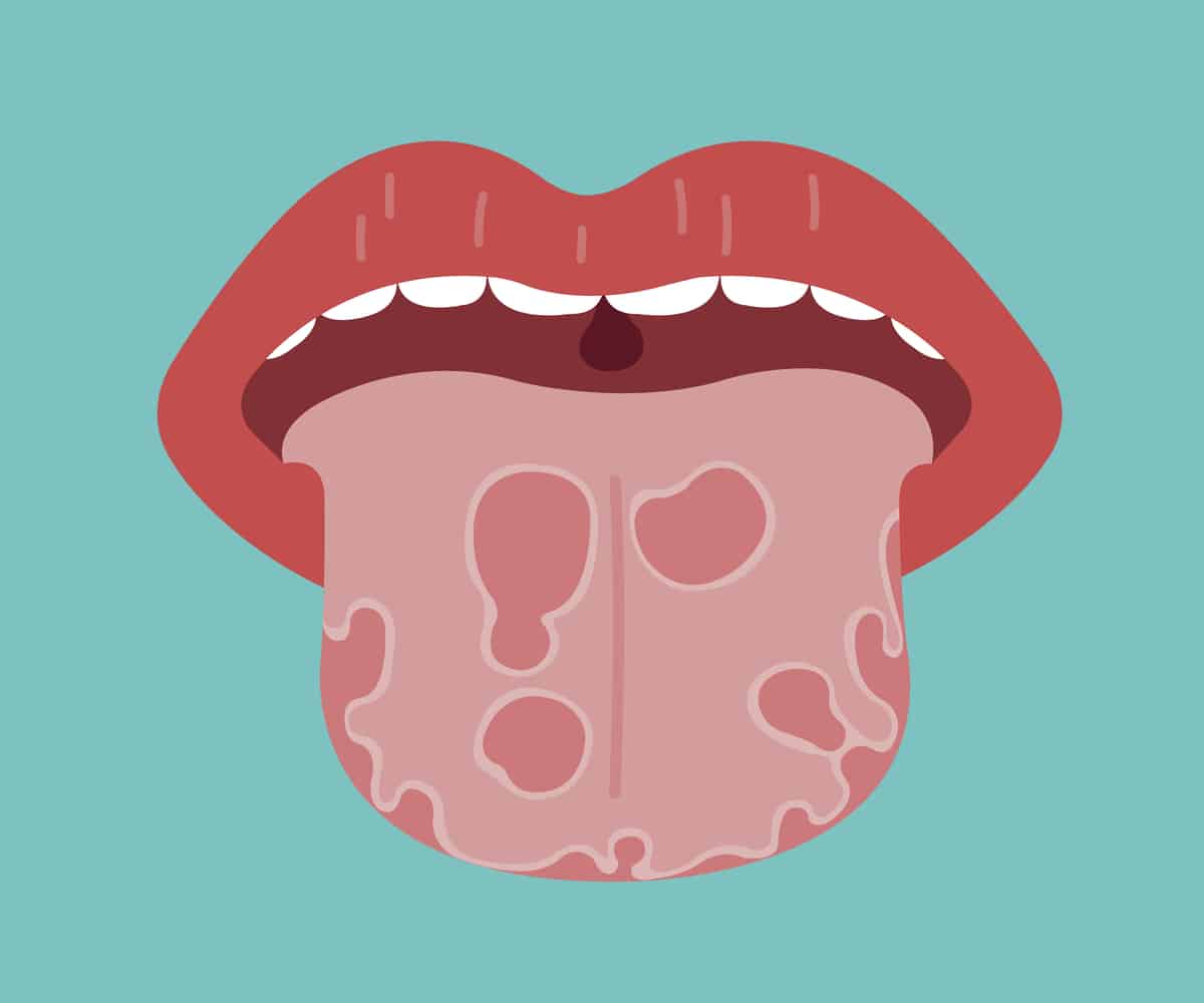 मुंह में HPV का कारण है ओरल सेक्स, कुछ ऐसे बचें इस इंफेक्शन से!