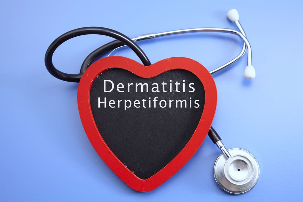 डर्मेटाइटिस हेरपेटिफॉर्मिस: त्वचा की इस समस्या से राहत पाने का उपाय है ग्लूटेन फ्री आहार