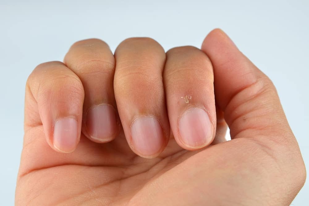 कहीं अनहेल्दी नाखूनों का कारण 'हैंगनेल' तो नहीं?