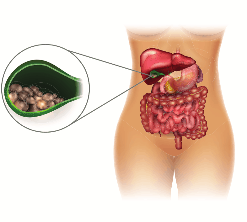 गॉल्स्टोन के लिए घरेलू नुस्खे में शामिल करें 5 🥣 चीजें और ये🧘🏻‍♀️ योगासन!