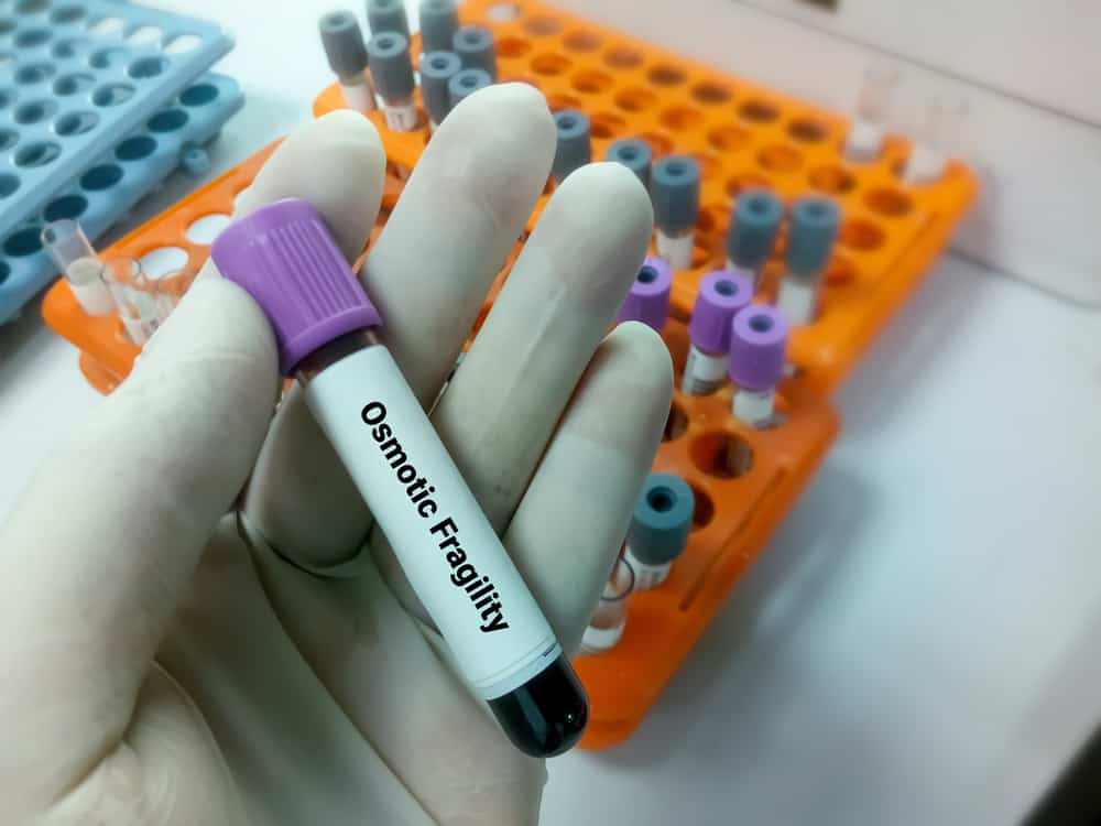 OFT: ऑस्मोटिक फ्रेजिलिटी टेस्ट क्या हैं?