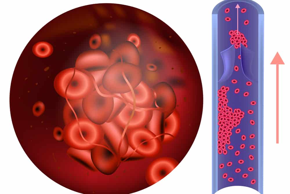 फैक्टर II डेफिशियेंसी : शरीर में इस प्रोटीन की कमी पड़ सकती है भारी!