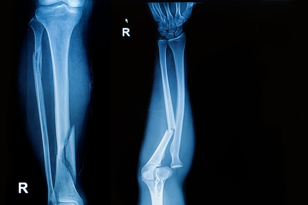 Spiral Fracture: स्पायरल फ्रैक्चर से जुड़ी कंप्लीट इंफॉर्मेशन है यहां!
