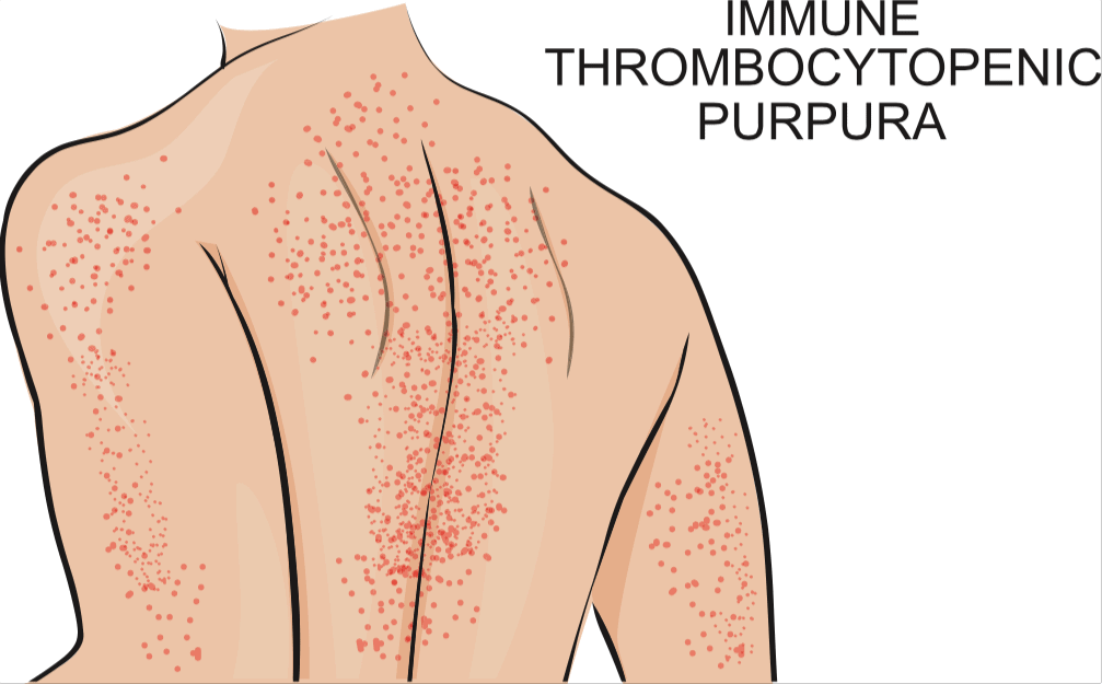 ITP Diet: प्लान में कौन सा फूड है 'इन' और कौन है 'आउट'? जानिए यहां