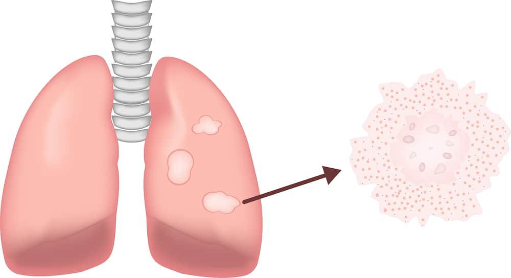 क्या कैल्सीफायड ग्रेन्युलोमा बन सकता है कैंसर का कारण? जानिए!