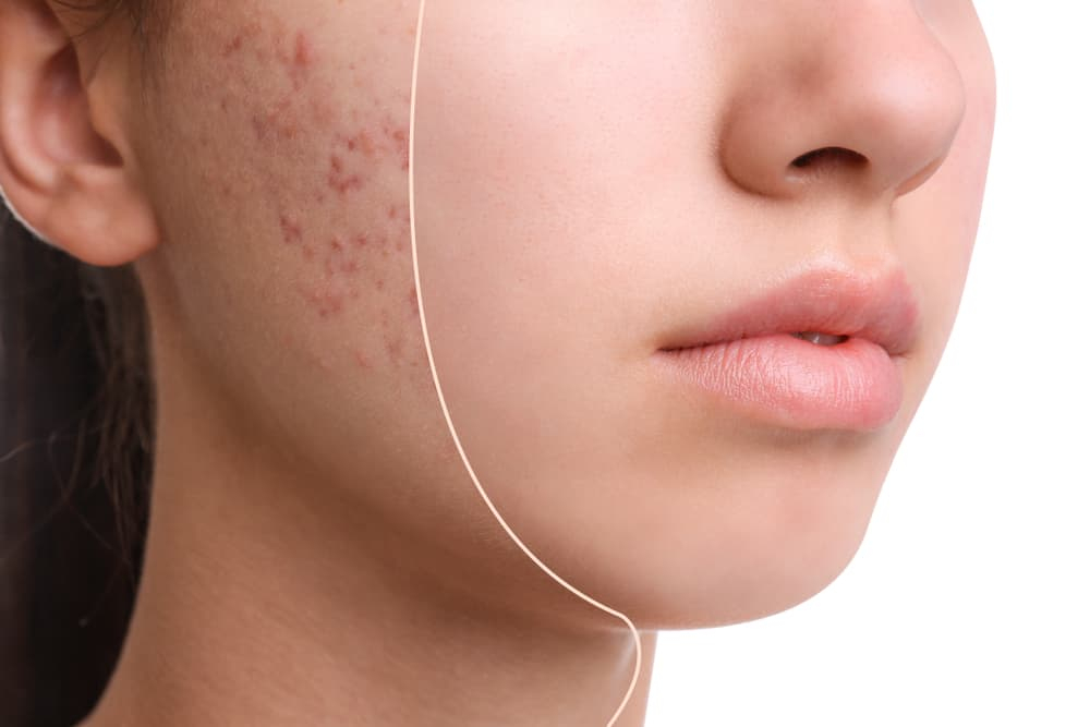Hormonal Acne: कैसे निपटे हॉर्मोनल एक्ने से?