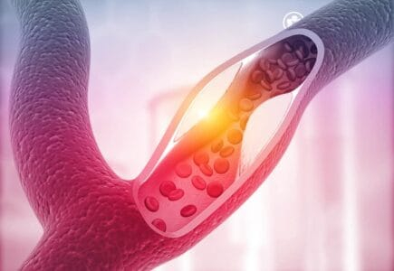 एथेरोस्क्लेरोसिस पैथोजेनेसिसि क्या है, कैसे होता है प्लाक का निर्माण?
