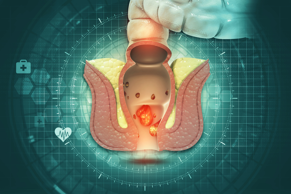 एनल कैंसर को कहीं आप पाइल्स समझकर इग्नोर तो नहीं कर रहें?