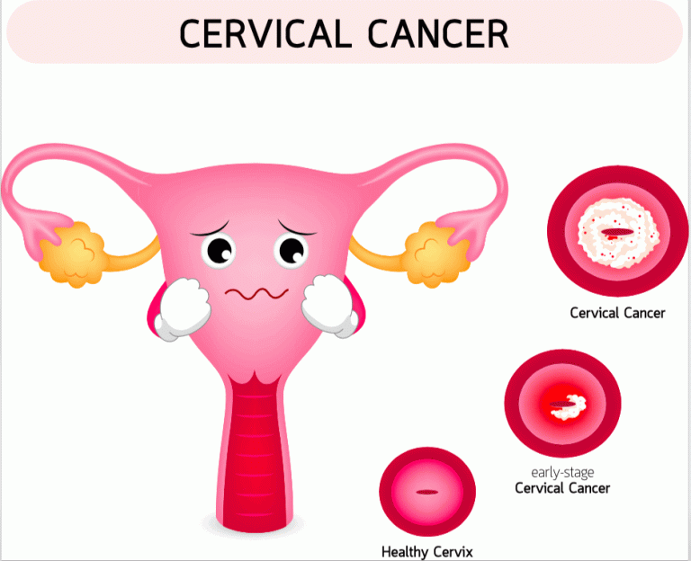 Causas de cancer de utero